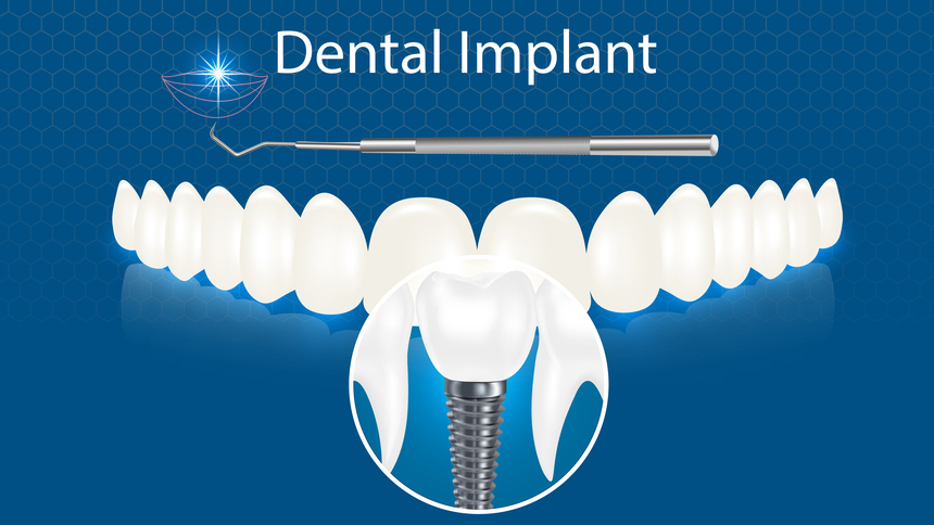 Dental Implant in Govind Nagar Nashik