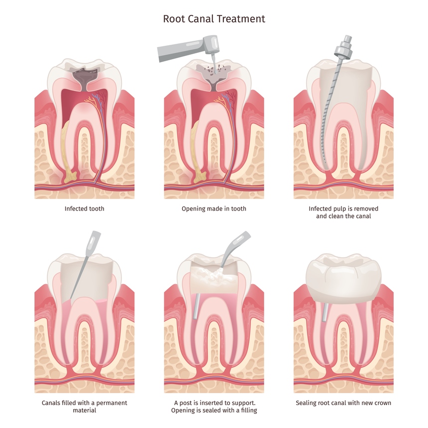 Painless Root Canal in Govind Nagar Nashik