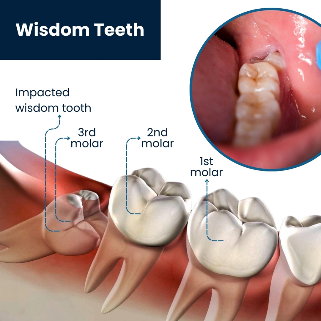 Wisdom Tooth Removal in Govind Nagar Nashik