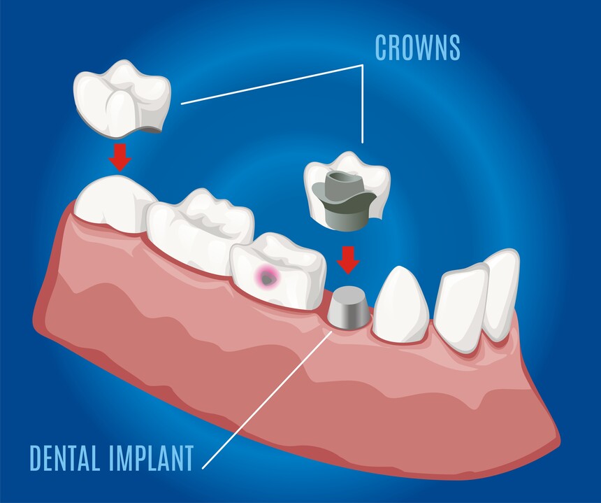 Dental Caps