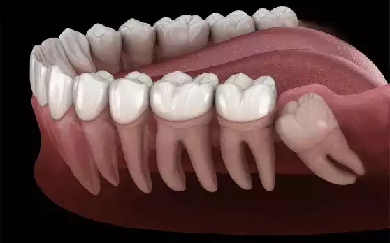Wisdom Tooth Removal